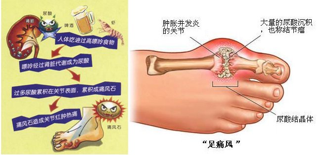 脚痛风如何治疗?足痛风去哪里治?