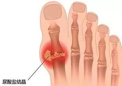 痛风石一般长在哪些部位?成都风湿医院好不好? 痛风石一般长在哪些部位?成都风湿医院好不好?